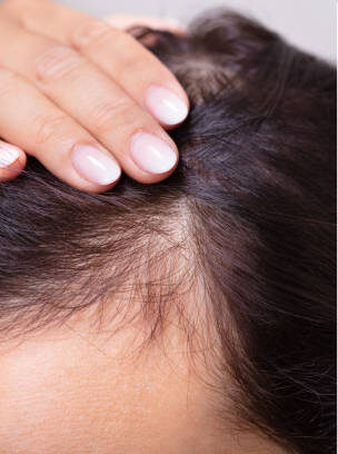 Woman Before And After Hair Loss Treatment