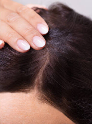Woman Before And After Hair Loss Treatment
