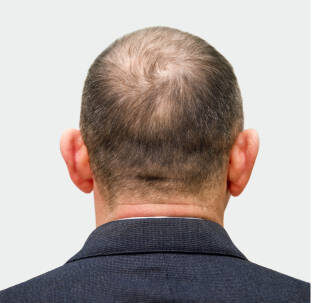 The head of a balding man before and after hair transplant surgery. A man losing his hair has become shaggy. An advertising poster for a hair transplant clinic. Treatment of baldness