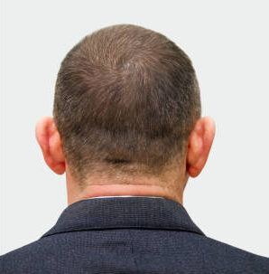 The head of a balding man before and after hair transplant surgery. A man losing his hair has become shaggy. An advertising poster for a hair transplant clinic. Treatment of baldness