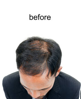 before and after bald head of a man on white background.