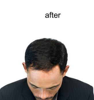 before and after bald head of a man on white background.